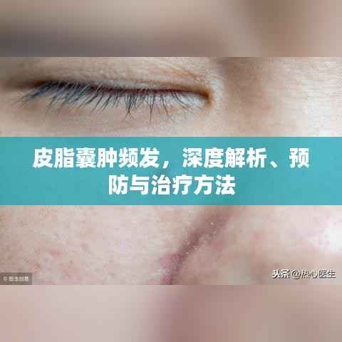 皮脂囊肿频发,深度解析、预防与治疗方法